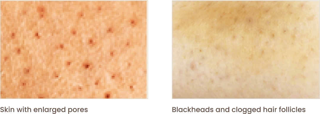 Skin with enlarged pores | Blackheads and clogged hair follicles